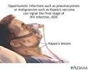 Acquired Immune Deficiency Syndrome (AIDS) Images: Learning Center ...