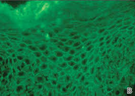 Attēlu rezultāti vaicājumam “Pemphigus borealis”