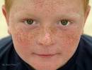 What's Prettier Than Freckles?