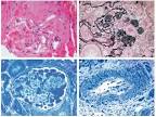 Modern Pathology - Figure 1 for article: Fabry disease: a ...