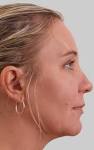 No Surgery Liposuction   Exilis Body Shaping in Las Vegas