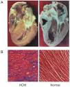 HYPERTROPHIC CARDIOMYOPATHY. Causes, symptoms, treatment ...