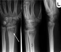 <b>osteomyelitis</b> x-ray