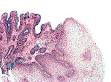 Barrett's esophagus - Wikipedia, the free encyclopedia
