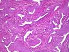 in <b>adenosquamous carcinoma</b>