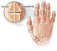 In <b>osteoarthritis</b>, the