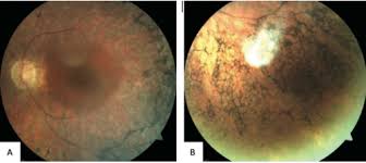 Attēlu rezultāti vaicājumam “Reticularia sp.”