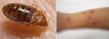 Image result for bed bug bites
