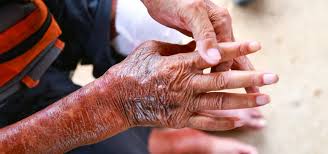 Attēlu rezultāti vaicājumam “Scleroderma”