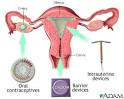 Birth control methods