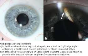 Kuvahaun tulos haulle Kayser-Fleischer