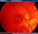 a pigmented <b>choroidal</b>