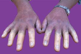 Attēlu rezultāti vaicājumam “Scleroderma”