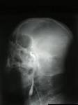 File:<b>Angiografia</b> - smierc