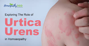 Attēlu rezultāti vaicājumam “Urtica urens”