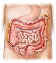 DIVERTICULITIS - EmpowHER.