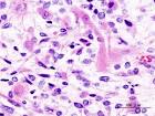 File:Uterine carcinosarcoma (5) rhabdomyosarcomatous.jpg ...