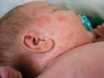 Measles Outbreak in Orange County - Babble