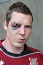 Chris Dunn Chris Dunn of Northampton Town poses with an eye injury sustained ... - Chris+Dunn+Northampton+Town+FC+Training+sR4fYd9Ule9l