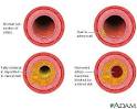 of atherosclerosis in