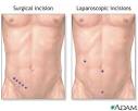 Appendectomy surgery - procedure and complications | Health Dictionary