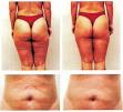 Mesotherapy Cellulite Treatment Clearwater FL   Clearwater