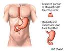 Gastrointestinal Bleeding | Health Dictionary