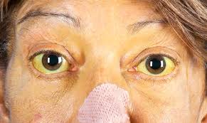 Kuvahaun tulos haulle Kayser-Fleischer