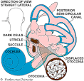 BPPV -- Benign Paroxysmal Positional Vertigo