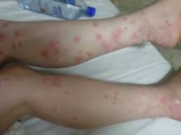 Image result for bed bug bites