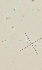 Attēlu rezultāti vaicājumam “Hyalorbilia inflatula”