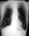 Pneumoperitoneum
