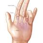 q=https%3A%2F%2Fwww.assh.org%2f Andcare%2f Condition%2f Trigger-finger from www.mayoclinic.org