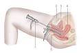Hysteroscopy - NHS Choices