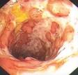 ¿Qué es la <b>enfermedad</b> de Crohn
