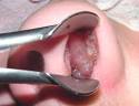 Pictures of Nasal Polyps (Nasal Polyposis) >>>Otolaryngology Houston