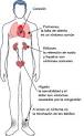La <b>hipertensión pulmonar</b>