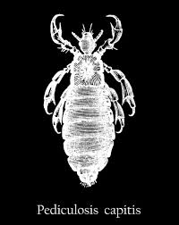 Attēlu rezultāti vaicājumam “Pediculus humanus capitis”