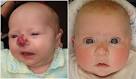 MARKED OUT: Heather Ward at seven weeks, left, and now at eight months, ... - 3207580