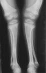 X-ray in <b>rickets</b>