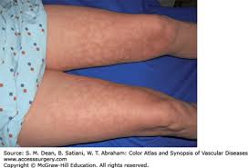 Attēlu rezultāti vaicājumam “Reticularia sp.”