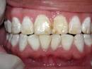 Avoid Fluoride Nourishing Our Children