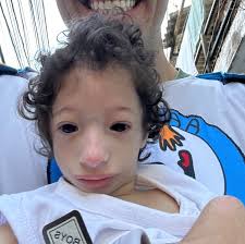 Image result for Nanismo Primordial