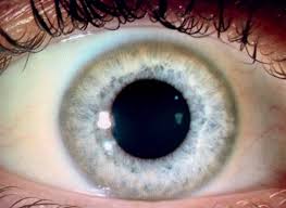 Kuvahaun tulos haulle Kayser-Fleischer