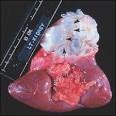 Echinococosis-An Emerging Parasite in the Immigrant Population ...