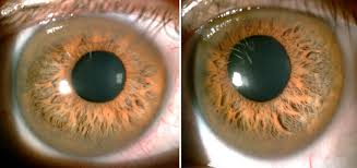 Kuvahaun tulos haulle Kayser-Fleischer