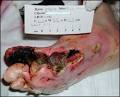 <b>Diabetic foot</b> ulcers