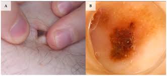 Attēlu rezultāti vaicājumam “Diderma umbilicatum young”