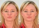 The limbal ring is the line