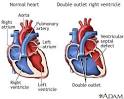 <b>Double outlet right ventricle</b>